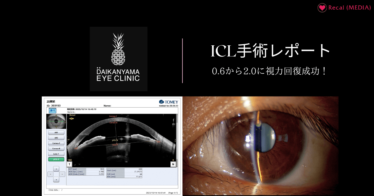 視力回復】代官山アイクリニックでICL手術レポート｜費用・流れ・見え